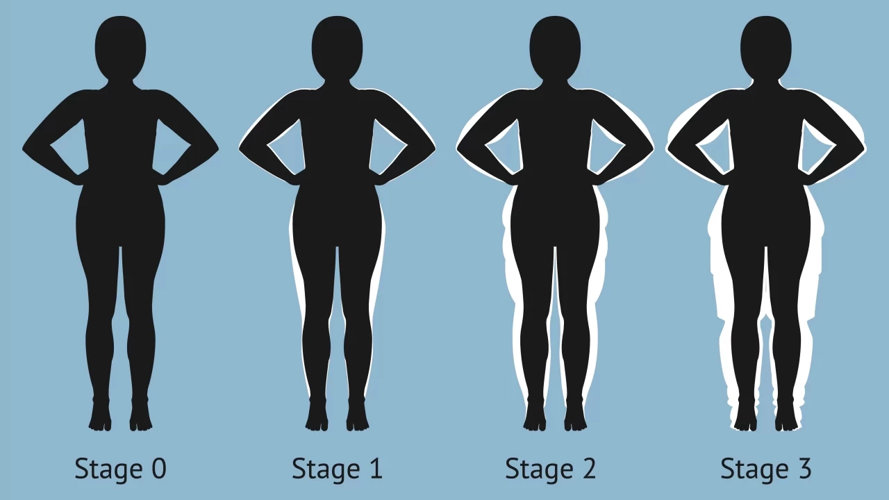 Diyet ve Spor Zayflamak in Yetmiyorsa Lipdeme Dikkat