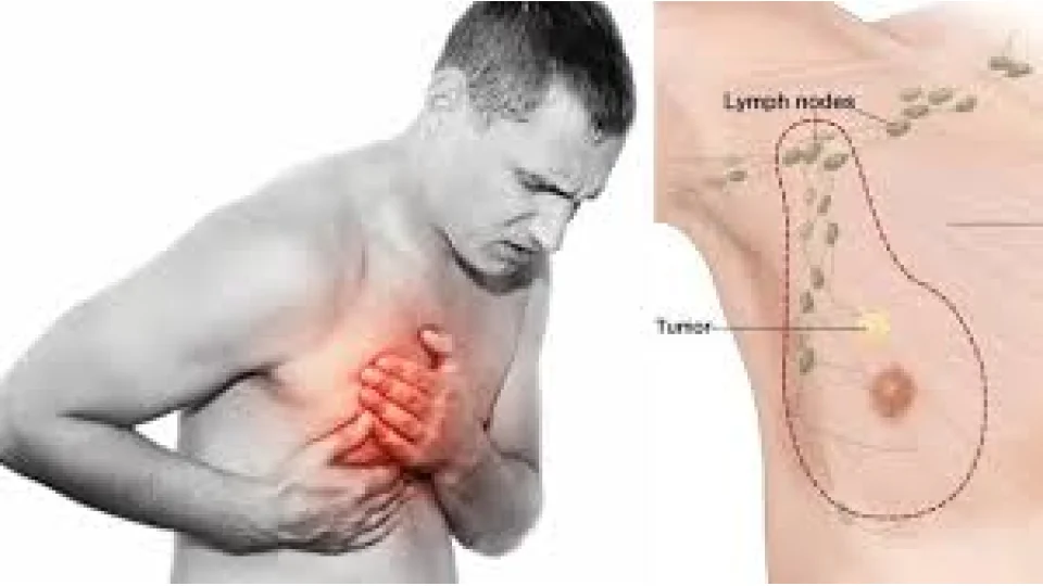 Erkeklerde Meme Kanseri: Az Bilinen Ama Ger�ek Bir Hastal�k