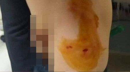 Mardin'de sokak köpeği 6 yaşındaki çocuğu ısırdı
