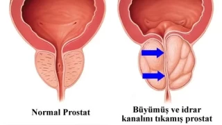 Prostat hastalığı ve tedavisi