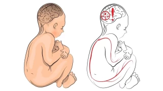 Serebral Palsi nedir?