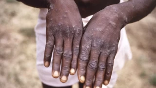 Afrika'da maymun çiçeği salgını