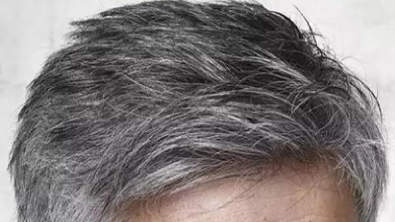 Gen�lerde sa� beyazlamas�n�n nedenleri