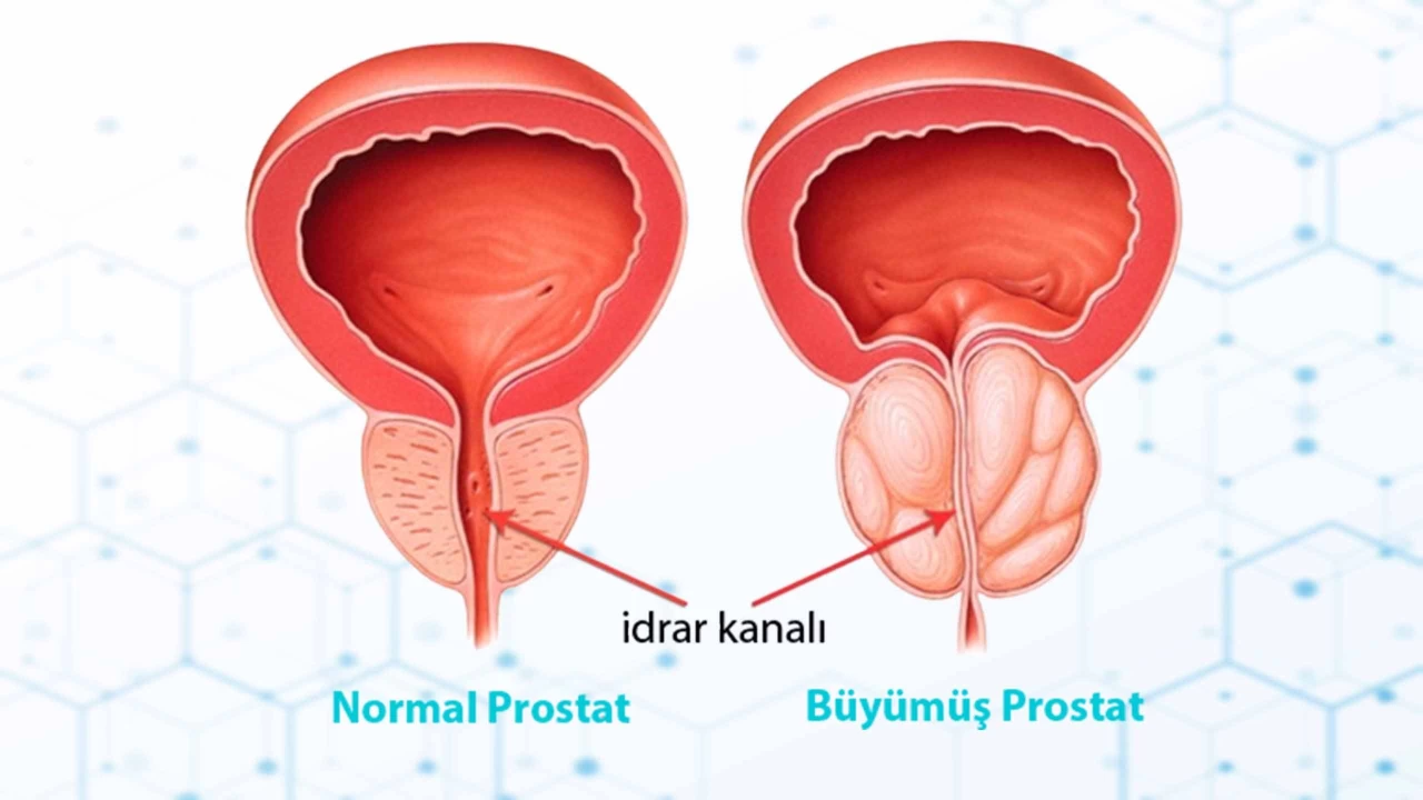 Prostat bymesi: Nedir ve neden oluur?