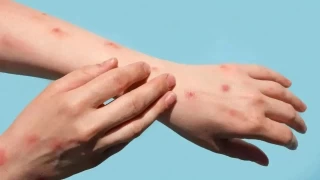 Sağlık Bakanlığı, M çiçeği hastalığına Türkiye'de rastlanmadığını duyurdu