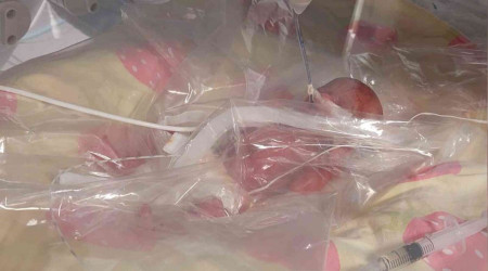 Tekirdağ'da 310 gramlık bebek doğdu