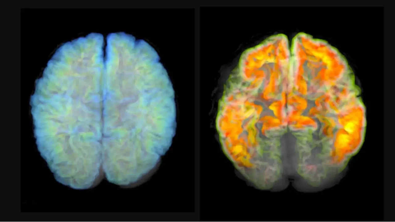 Alzheimer tedavisinde ila umudu