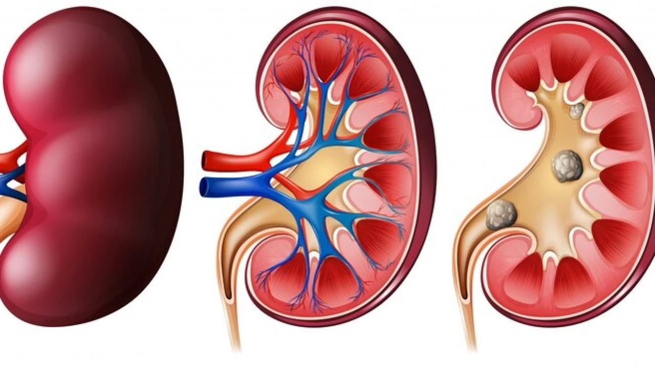 B�brek ta�lar�: Olu�umu, belirtileri ve tedavisi