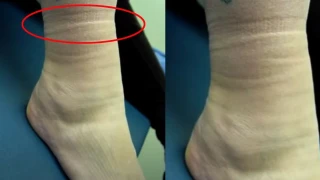 �orap �zleri Kalp ve B�brek Hastal���n�n Habercisi Olabilir