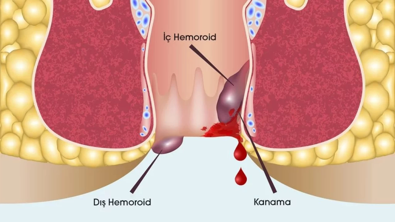 Hemoroit yaygın bir hastalıktır, tedavi edilebilir