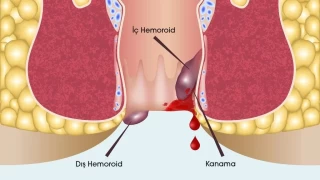 Hemoroit yaygın bir hastalıktır, tedavi edilebilir