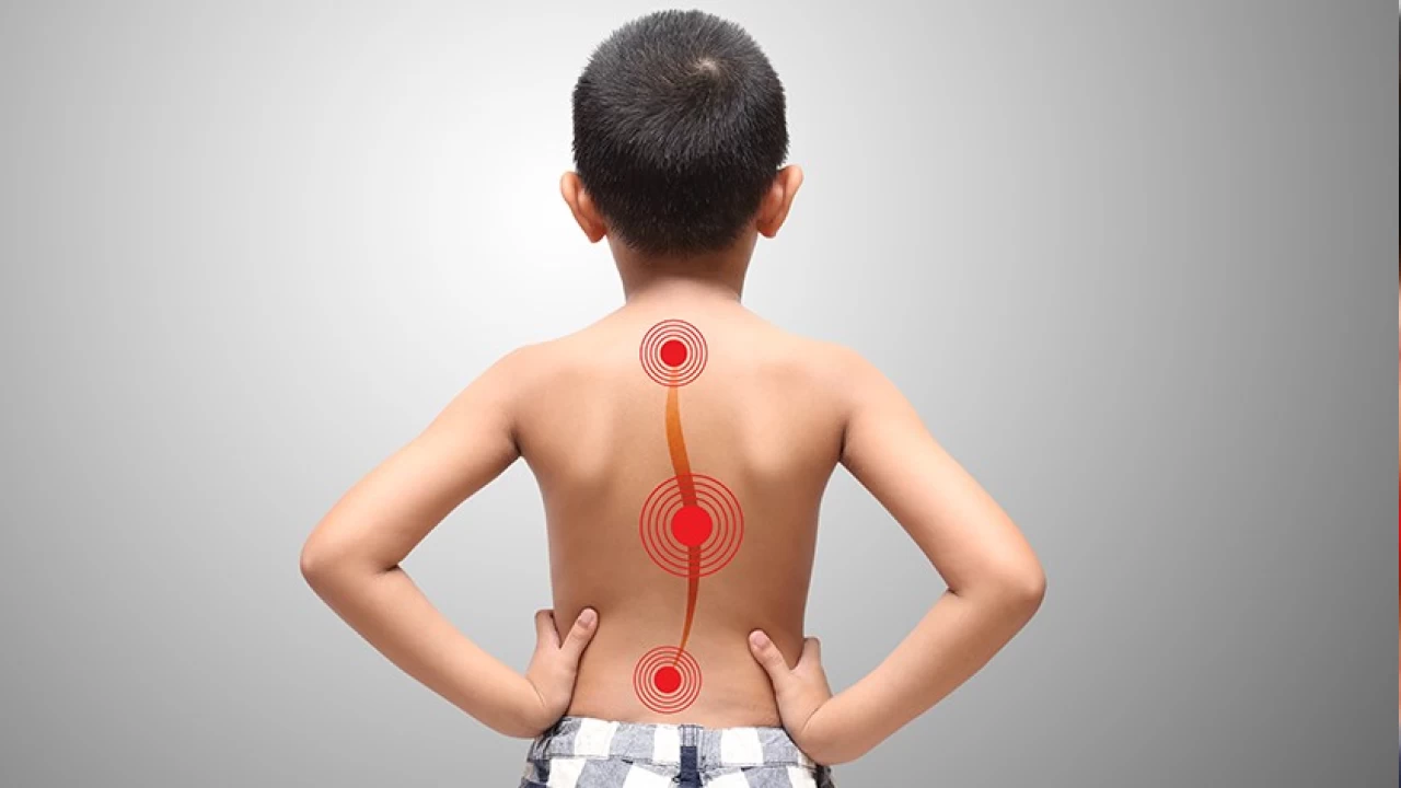 Skolyoz tedavisinde erken te�his �nemlidir