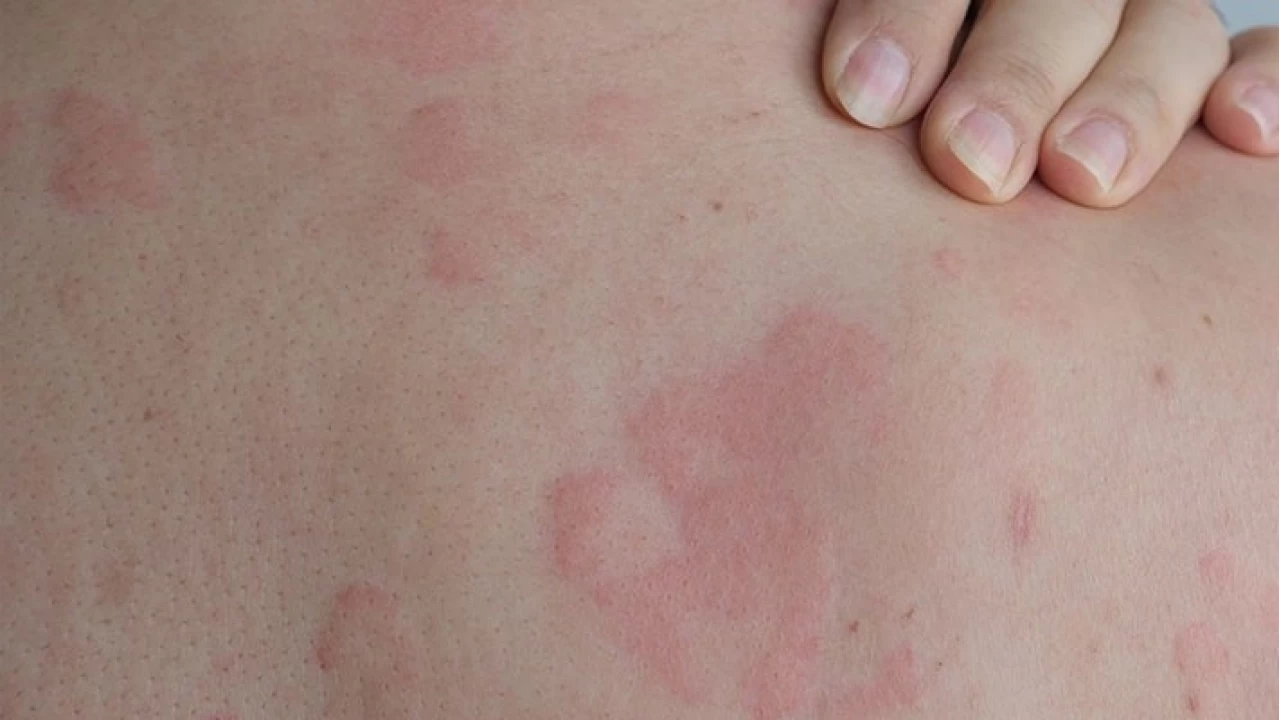 Vücutta aniden çıkan kızarıklıklar vücudun bize bir uyarısıdır