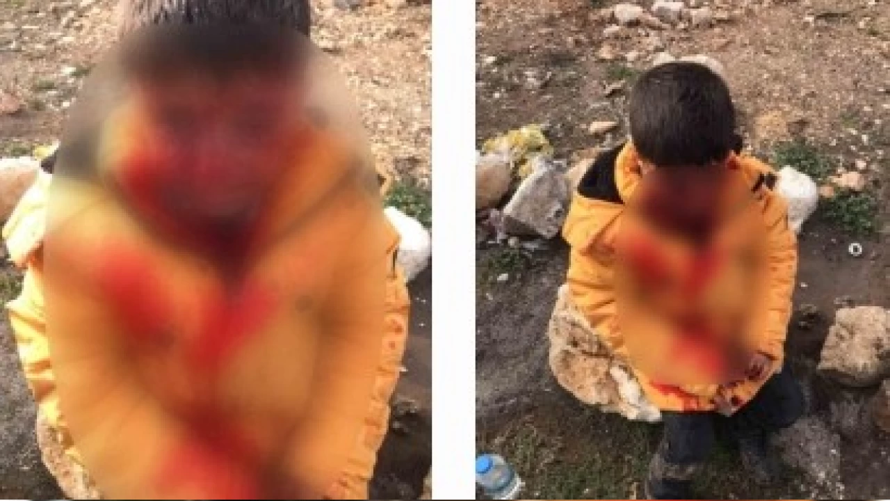 Adıyaman'da köpeklerin saldırdığı çocuk ağır yaralandı