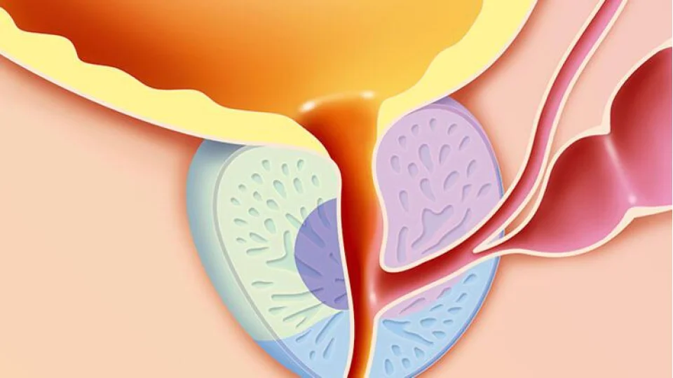 A�r� ve k�r�klara dikkat, prostat kanseri kemiklere yay�labilir