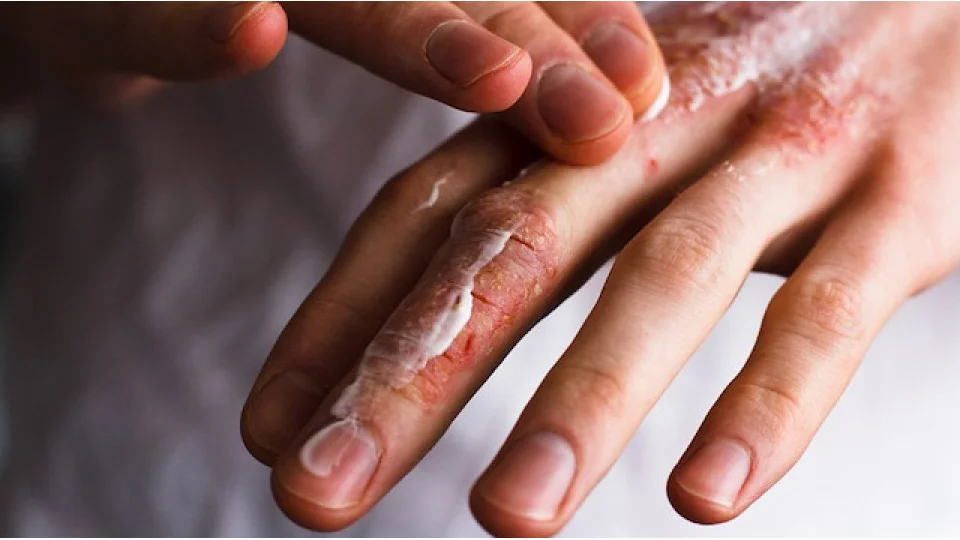 Kışın Soğuk Isırması Nedir?