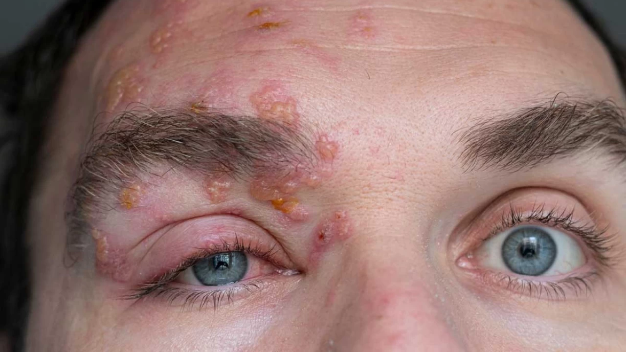 Erken tedavi edilmeyen zona hastal��� g�rme kayb�na sebep olabiliyor