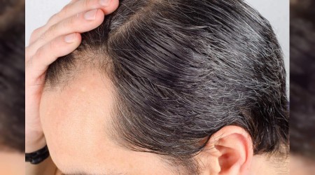Hormonal değişiklikler saçları dökebiliyor