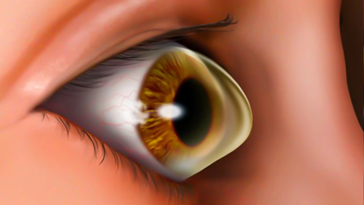 Keratokonusta g�rme kayb�na kar�� erken te�his �nemli