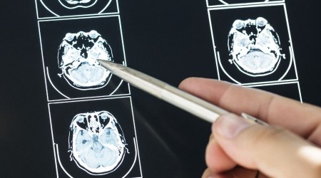 MS hastalığı kadınlarda 3 kat daha fazla görülüyor