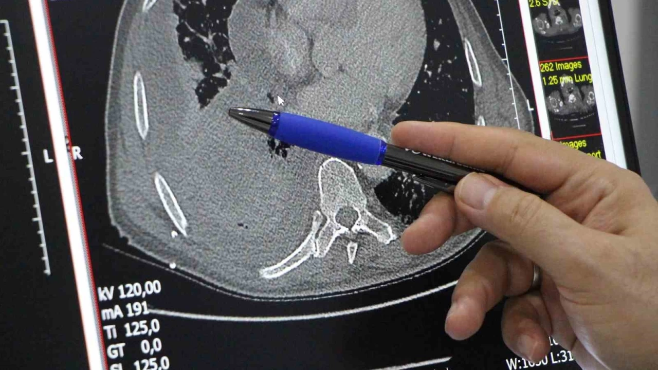 Akci�er kanserine y�lda 40 binden fazla ki�i yakalan�yor