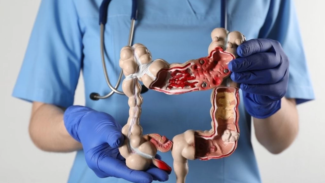 'Az sebze ve meyve tketimi, kolorektal kansere davetiye karyor'