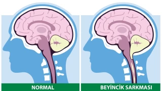 Beyincik sarkmas nedir?