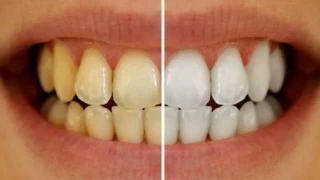 Diş sararmasını önlemenin pratik yolları