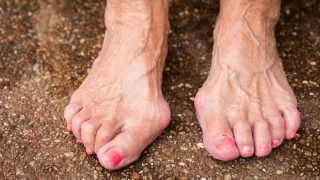 Halluks Valgus Nedir?