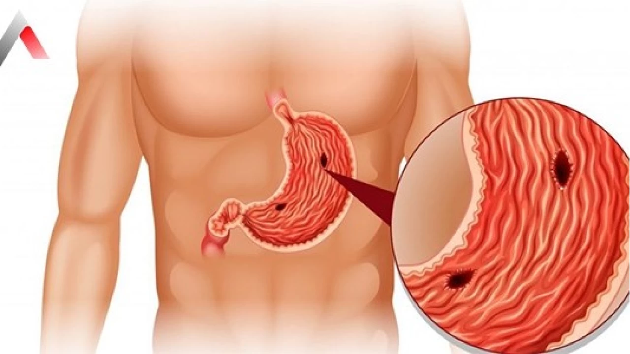 Ülser Nedir? Sessiz İlerlemenin Acılı Sonuçları
