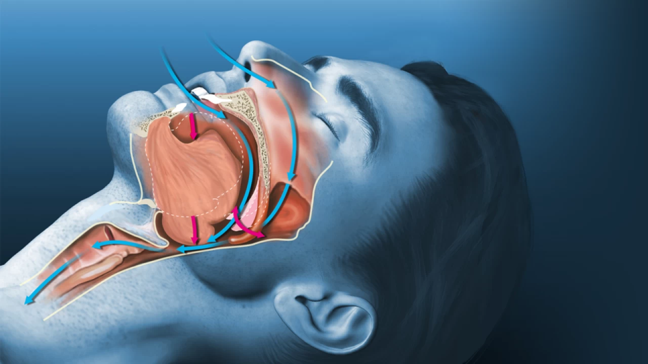 Uyku apnesi sorunundan robotik cerrahi ameliyatıyla kurtulmak mümkün