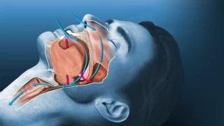Uyku apnesi sorunundan robotik cerrahi ameliyatyla kurtulmak mmkn