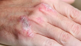 K�� Aylar�nda Cilt Kurulu�u ve Egzama �ikayetleri