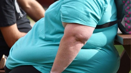 Obezite cerrahisi kalc sonu vermez
