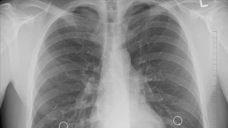  Akcier kanserinde evresel faktrlerin etkisi giderek artyor