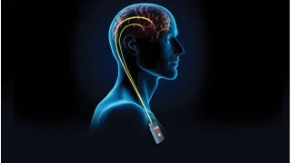 Derin Beyin Stim�lasyonu (DBS) nedir?