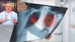Dr. Özkul: Türkiye’de her yıl 150 bin kişi kanserden ölüyor