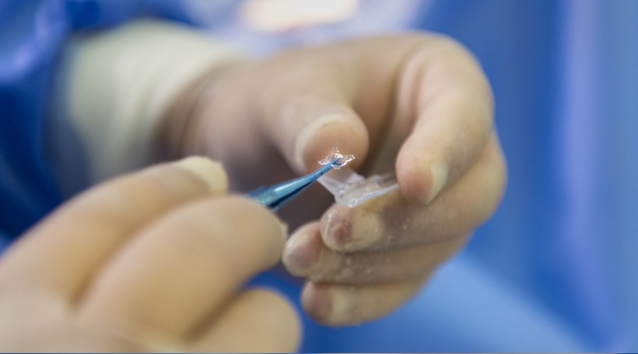 Katarakta ak�ll� lensli ��z�m