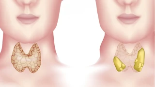 Zehirli guatr belirtileri ihmal edilmemeli