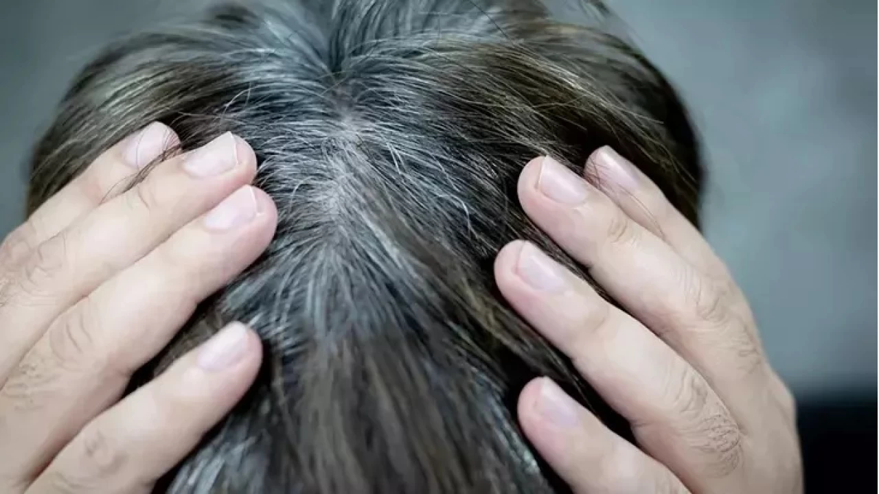 Saçların erken beyazlaması neyin işareti?