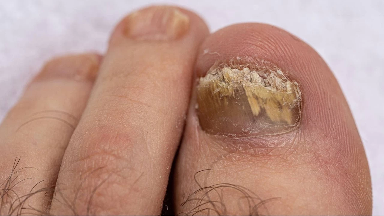 T�rnak mantar� doktor kontrol�nde tedavi edilmelidir 