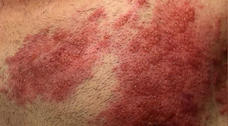 Covid-19 salgını sonrası viral hastalıklar coştu