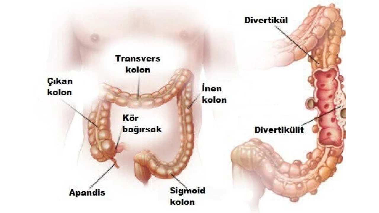 Divertikül kanaması nedir?