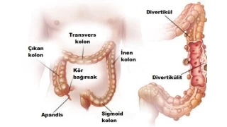 Divertikül kanaması nedir?
