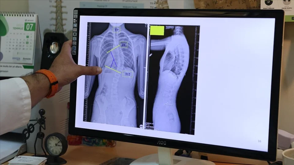 Omurgadaki Yan E�rilik: Skolyoz Nedir ve Nas�l �nlenir?