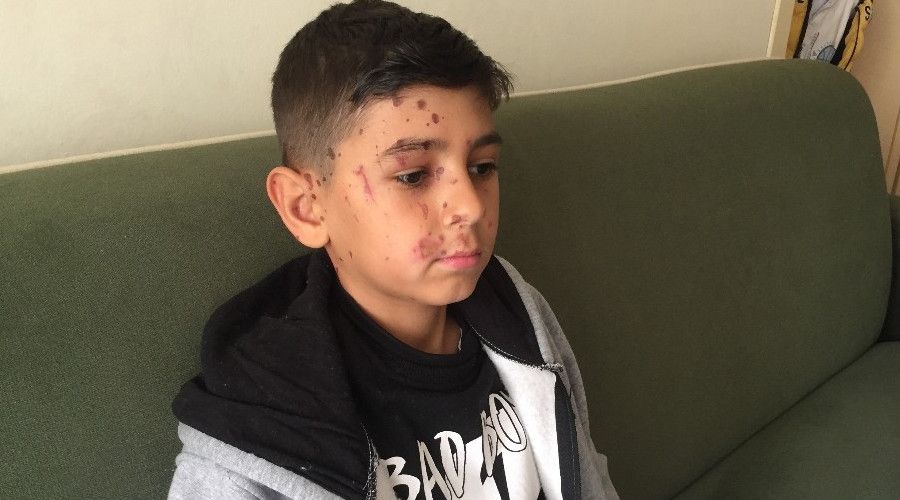 Arkadaşının attığı temizlik maddesi kör ediyordu