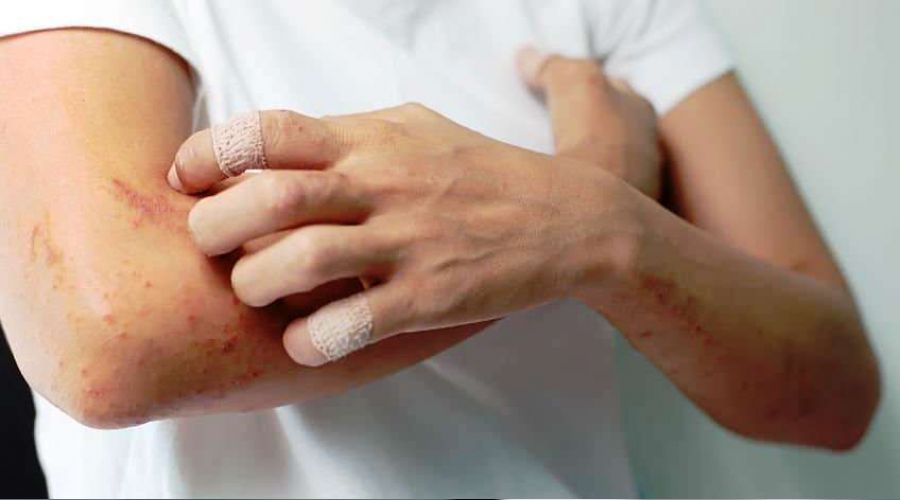 'K�� aylar�nda deri hastal�klar� art��a sebep olabiliyor'