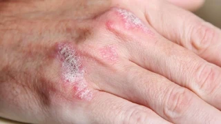 So�uklarda cilt kurulu�una kar�� 10 tavsiye