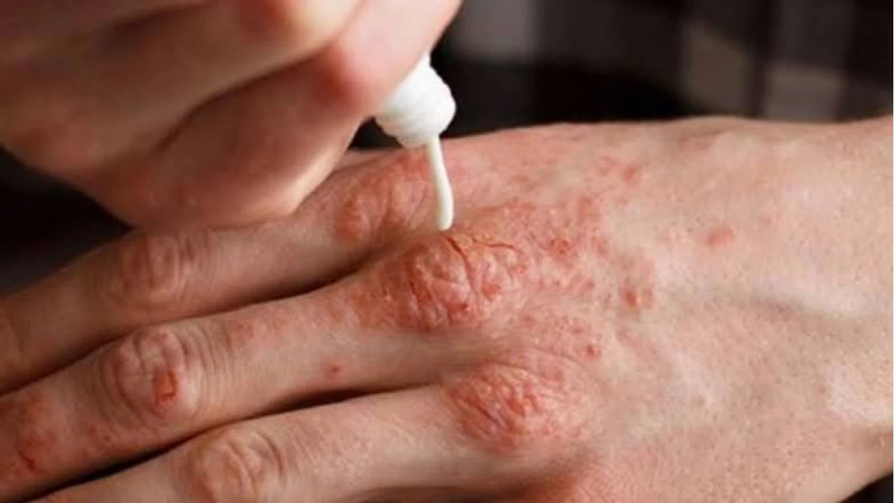 Mantar hastal��� ve egzama: Farklar�, belirtileri, tedavisi ve korunma y�ntemleri